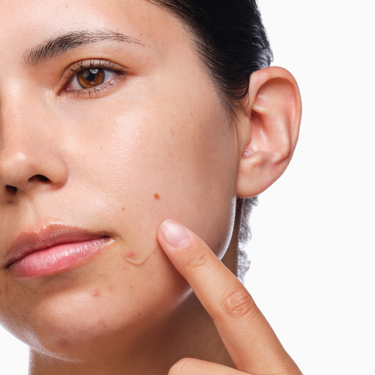 the-acne-set-h4 rdn-the-acne-set-application.png