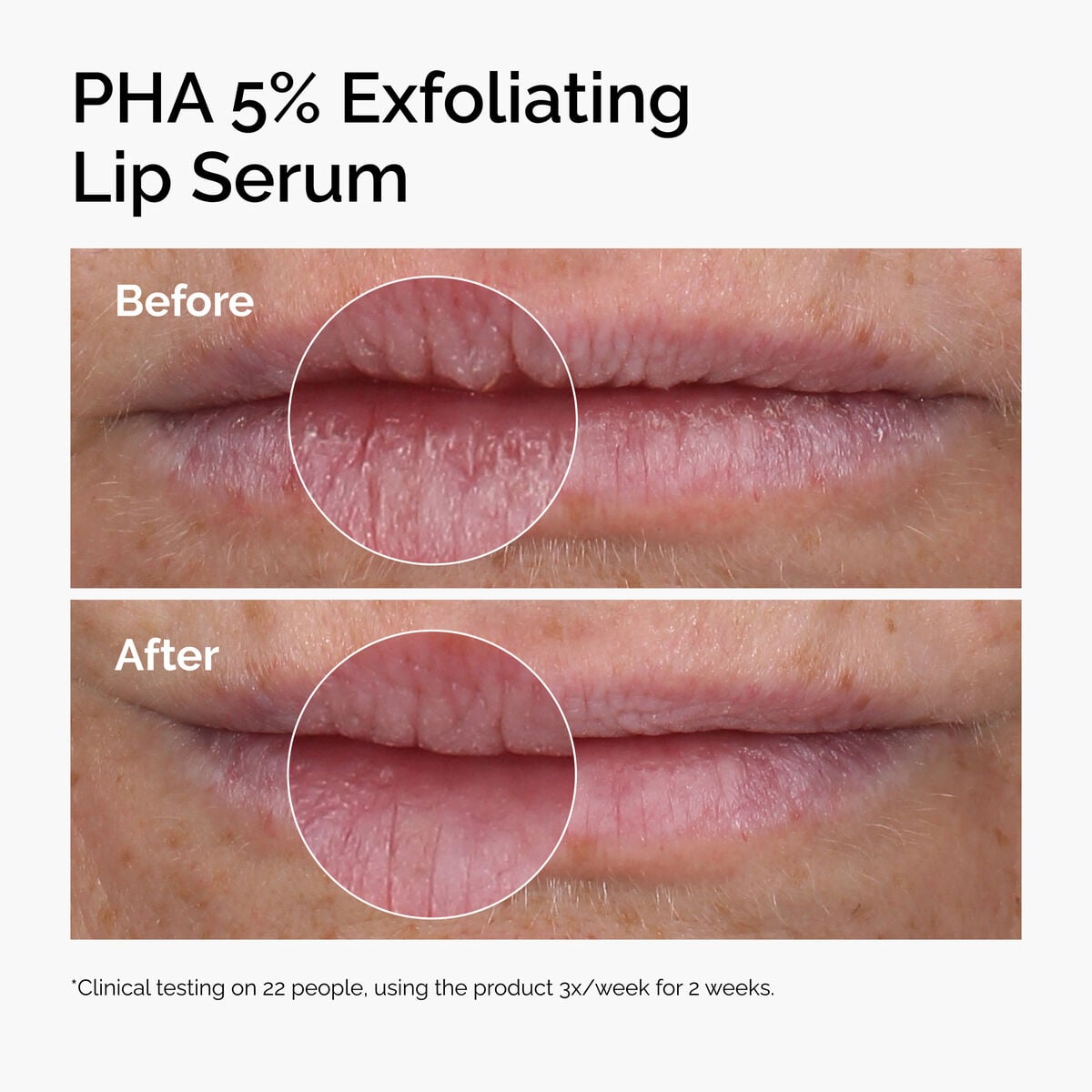 pha-5-exfoliating-lip-serum-a5 ord-pha-5pct-lip-exfoliating-serum-before-after.jpg