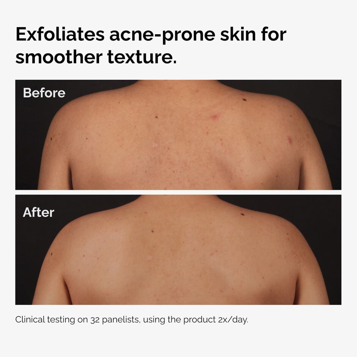salicylic-acid-0-5-body-serum-m4 ord-salicylic-acid-body-serum-before-after-graphic-NA.jpg