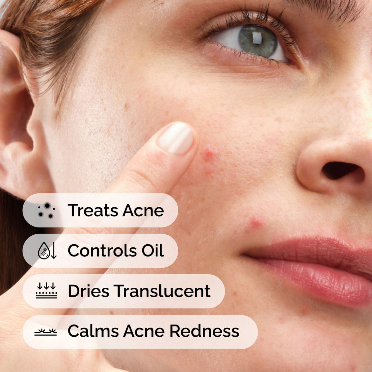 sulfur-10-powder-to-cream-concentrate-d9 ord-sulfur-10pct-powder-to-cream-concentrate-model-application-with-benefits-acne.jpg